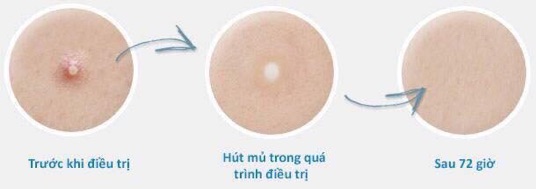Miếng dán mụn [COSRX] ACNE PIMPLE MASTER PATCH