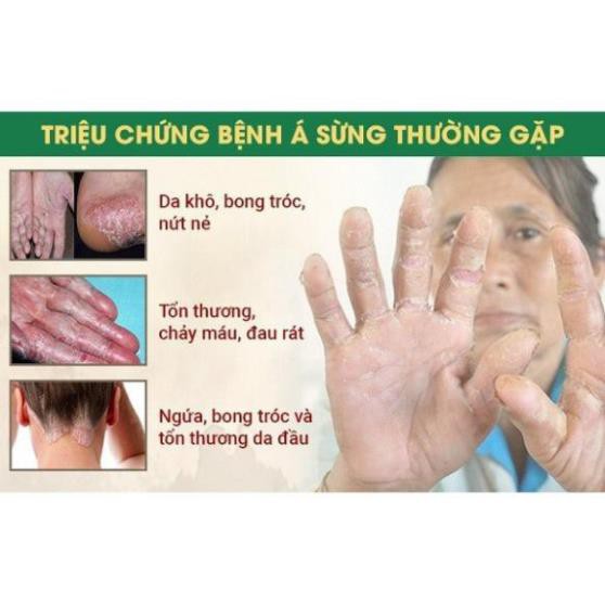 Kem Á Sừng,Giảm Viêm Da Cơ Địa,Vảy Nến Keratinamin Kowa Cream | BigBuy360 - bigbuy360.vn