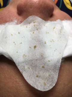 Ủ mụn đầu đen, mụn cám