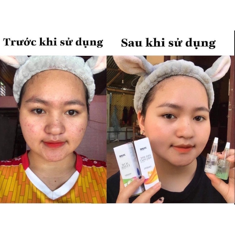 COMBO SERUM JIUHE THÂM VÀ SERUM JIUHE MỤN ACNES EXTRA THANH TÔ CHÍNH HÃNG 100%