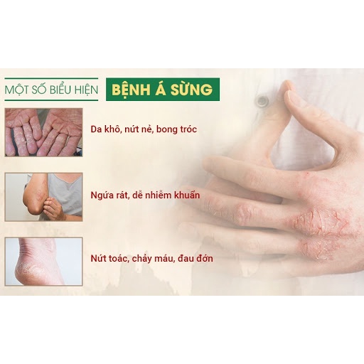 Kem Bôi Nứt Nẻ, A Sừng, Khô Da, Ngứa Tay Chân Ngoài Da (XL.01)