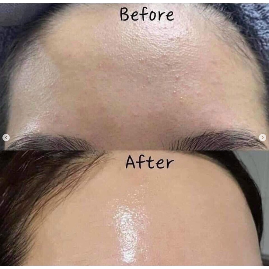 Tinh Chất Giảm Mụn Mờ Thâm SVR Sebiaclear 14% GLUCONOLACTONE + 4% NIACINAMIDE 30ml