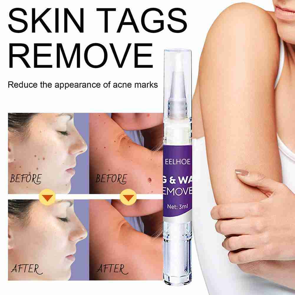 [Hàng mới về] Dung dịch loại bỏ mụn cóc / nốt ruồi A8T2