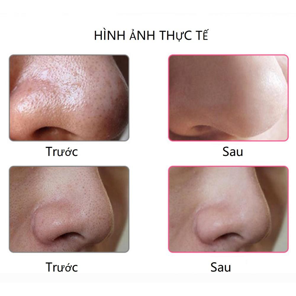 [BAY SẠCH MỤN] MÁY HÚT MỤN MINI CẦM TAY BLACK HEAD  3 chế độ [LỰC HÚT SIÊU MẠNH]