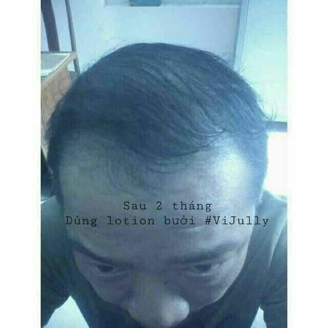 Tinh Dầu Bưởi Vi Jully  Mọc Tóc Cao Cấp - Giảm Rụng Tóc | BigBuy360 - bigbuy360.vn