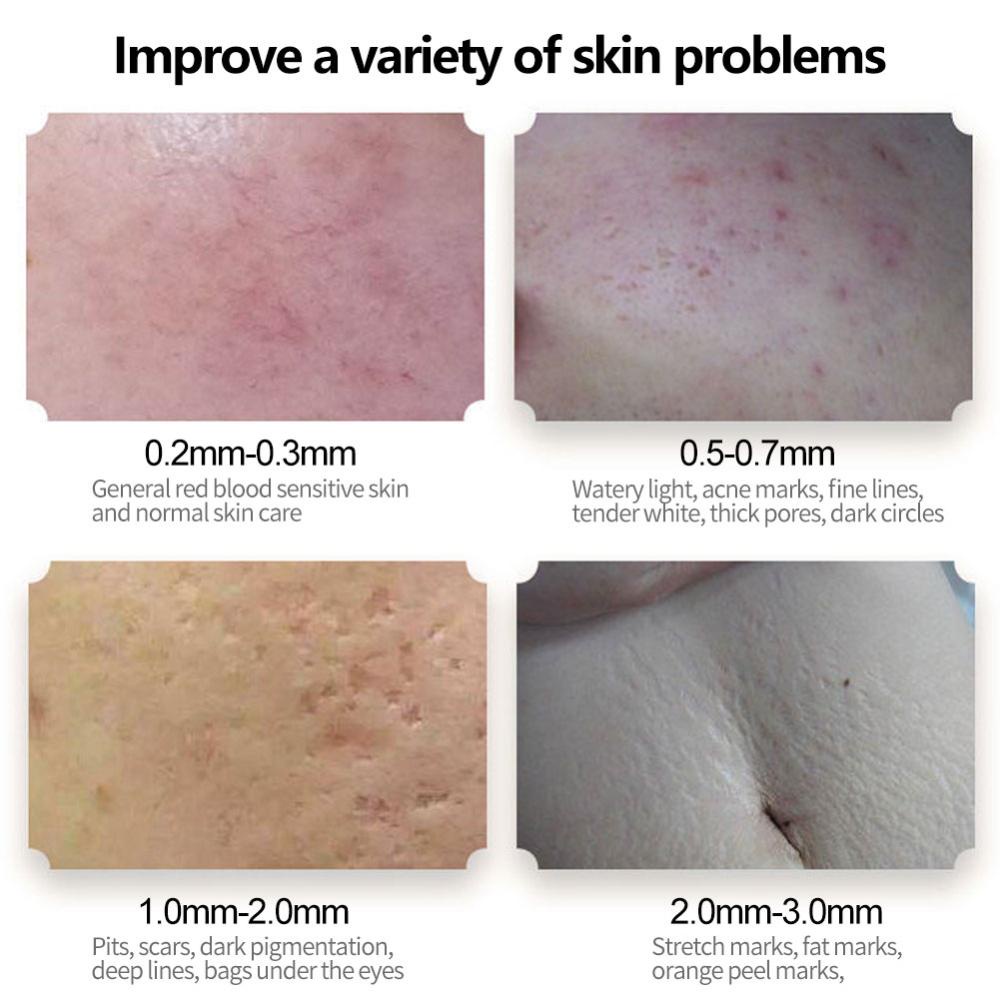 Cây Lăn Kim 540 Chăm Sóc Da Màu Đen 0.2-3.0mm T8Y3