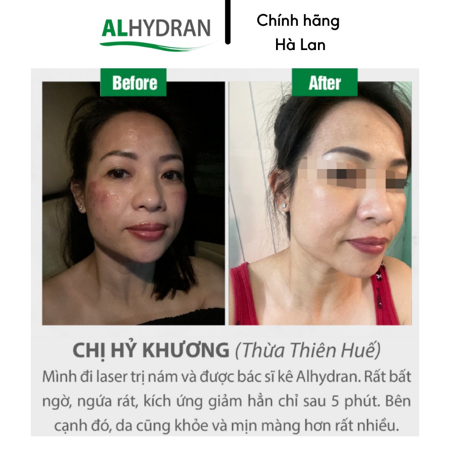 [CHÍNH HÃNG HÀ LAN] Kem Dưỡng Phục Hồi Da Chuyên Sâu  ALHYDRAN - Làm Dịu Da, An Toàn & Kích Thích Tái Tạo Da Tổn Thương