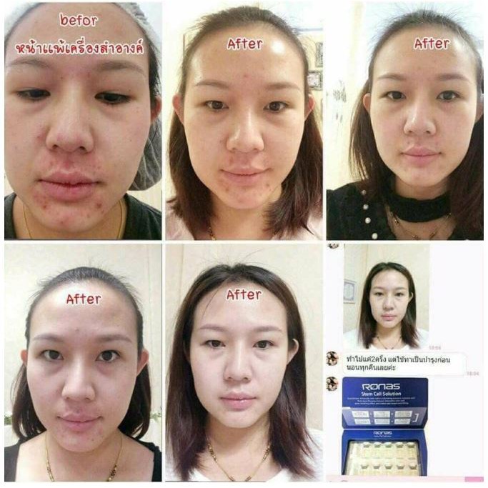 Tế Bào Gốc Ronas Stem Cell Hàn Quốc (1 hộp)