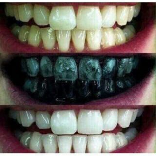 Kem đánh răng làm trắng than hoạt tính