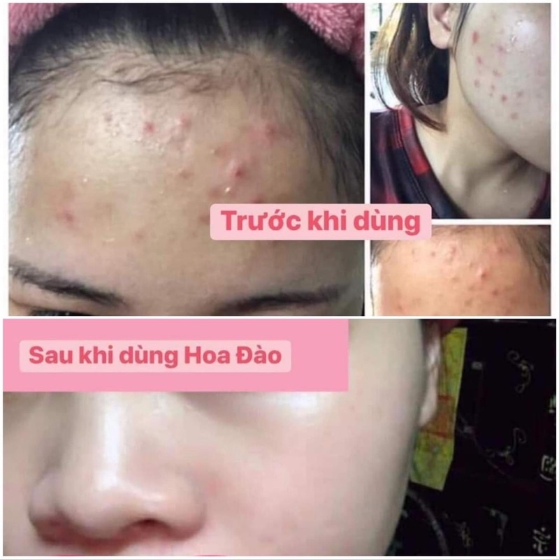 Kem khử mụn Hoa Đào dưỡng da trắng hồng sạch thâm láng mịn