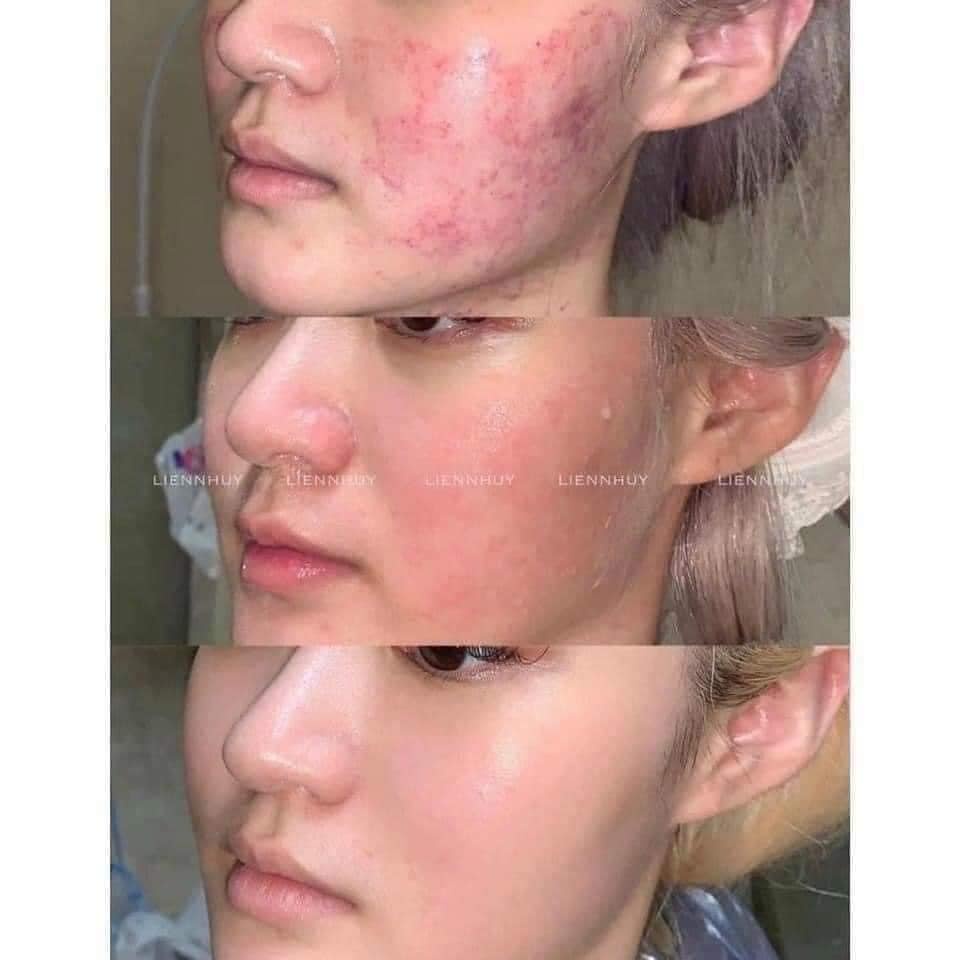 Kem dưỡng phục hồi da phù hợp cho trẻ em La Roche-Posay Cicaplast Baume B5