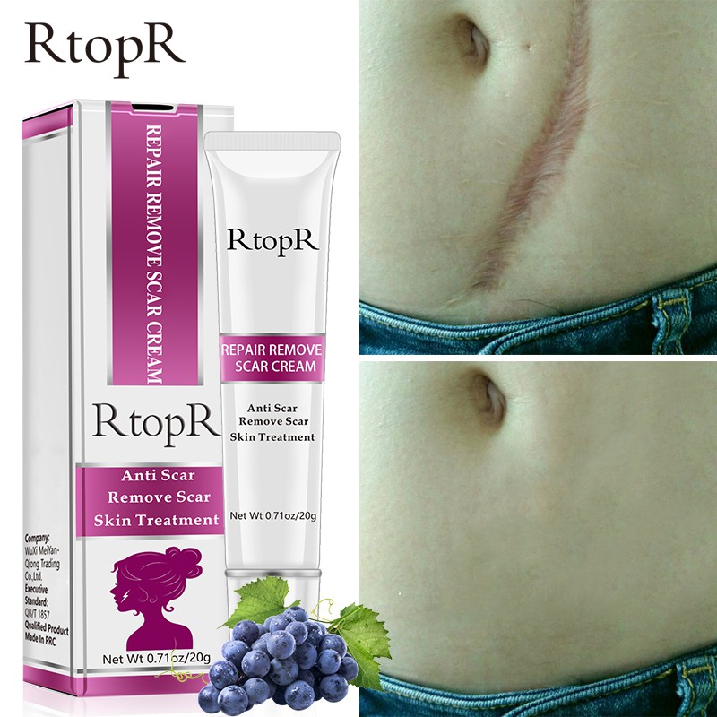 Kem bôi xóa sẹo RtopR 20g dưỡng ẩm làm trắng da làm mờ sẹo vết rạn vết chai cải thiện mụn đầu đen  | BigBuy360 - bigbuy360.vn