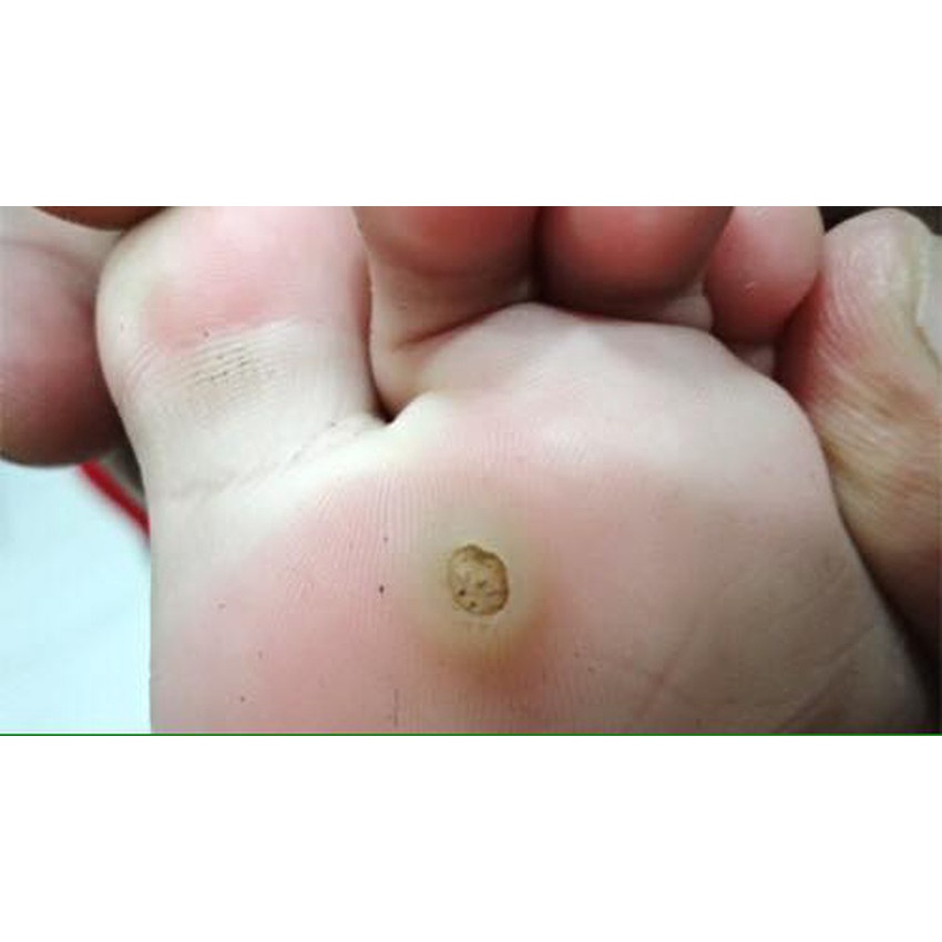 [Hàng mới về] Đánh bay MỤN CÓC với kem bôi Larifan Ungo từ Châu Âu