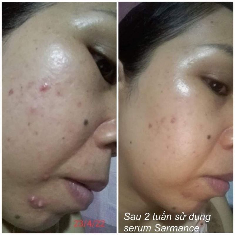 [CHÍNH HÃNG] SERUM Mũ Nho SARMANCE Sản Phẩm Hữu Cơ Nội Địa Pháp
