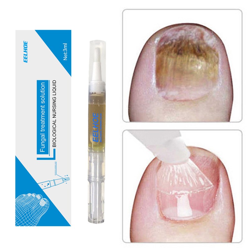 1 Cây Bút Dầu Trị Nấm Móng Tay / Móng Chân / Móng Chân Chăm Sóc Sức Khỏe Hiệu Quả 3ML
