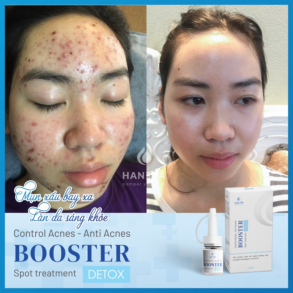Serum giảm mụn HANEVA, tinh chất ngừa, đánh bay mụn, sạch thâm, dưỡng trắng da hiệu quả chỉ sau 7 ngày