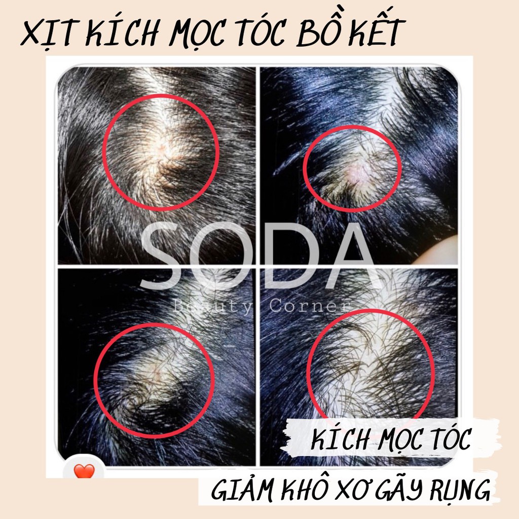 Xịt Kích Mọc Tóc Tinh Chất Bồ Kết Giảm Rụng Tóc, Giảm Hói Lâu Năm và Tóc Bị Bò Liếm - SODA Beauty Corner.