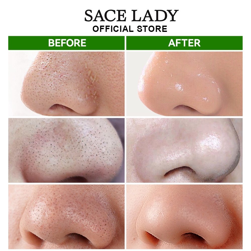 Set serum lột mụn đầu đen SACE LADY 10ml