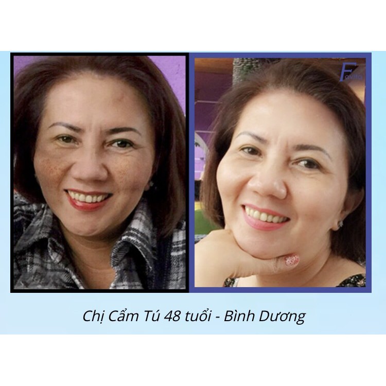 FAVITA PLUS đột phá trẻ hóa làn da chỉ sau vài tuần, loại bỏ nám, tàn nhang, làm mờ nếp nhăn, chống lão hóa da