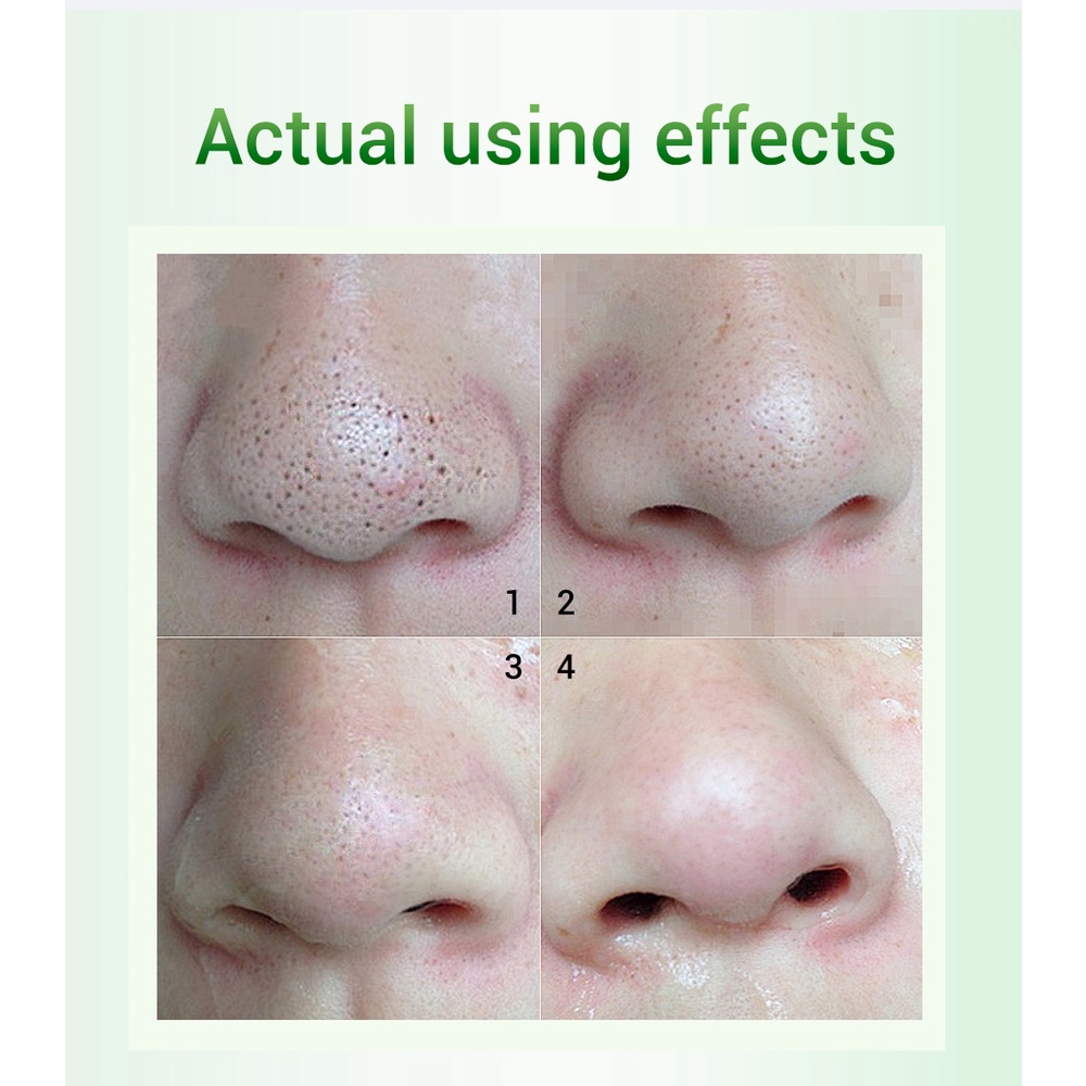 Mặt Nạ Lột Mụn Đầu Đen Breylee Giúp Se Khít Lỗ Chân Lông