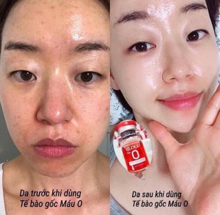 TẾ BÀO GỐC BLOOD O