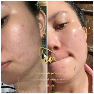 (COMBO GIÁ SỈ) TINH CHẤT - NẠ - SEN VIP - SERUM