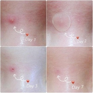 Miếng dán mụn Cosrx Acne Pimple Master Patch