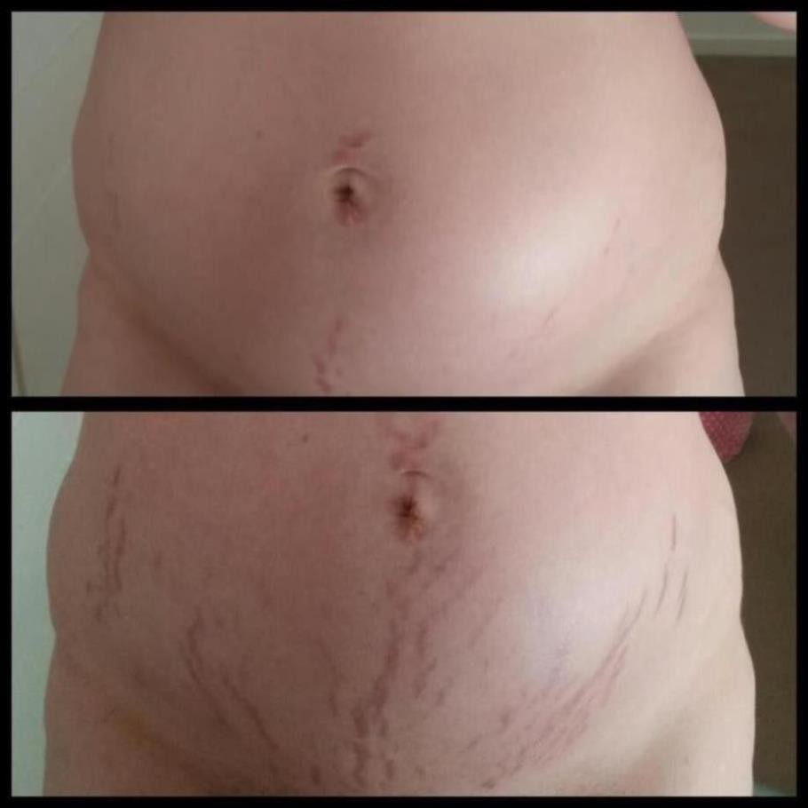 Stratamark 20g 50g - kem mờ vết rạn da của chuyên gia Thụy sỹ | BigBuy360 - bigbuy360.vn
