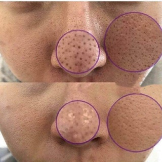 Đầu máy rửa mặt massage LUMISPA NUSKIN