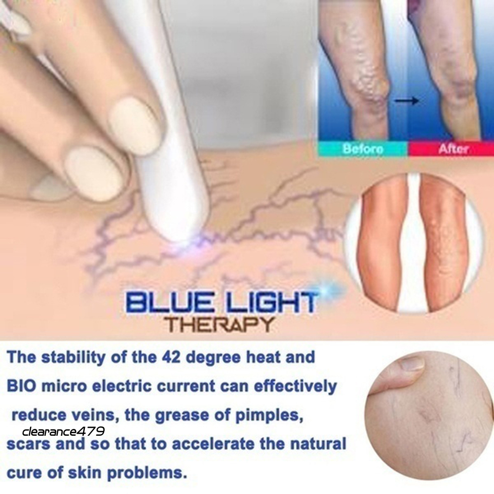 (Hàng Mới Về) Bút Laser Trị Mụn / Tàn Nhang / Vết Thâm Sử Dụng Công Nghệ Ánh Sáng Xanh Lam 479