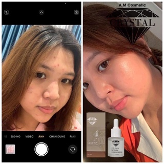 SERUM BHA TRI MỤN