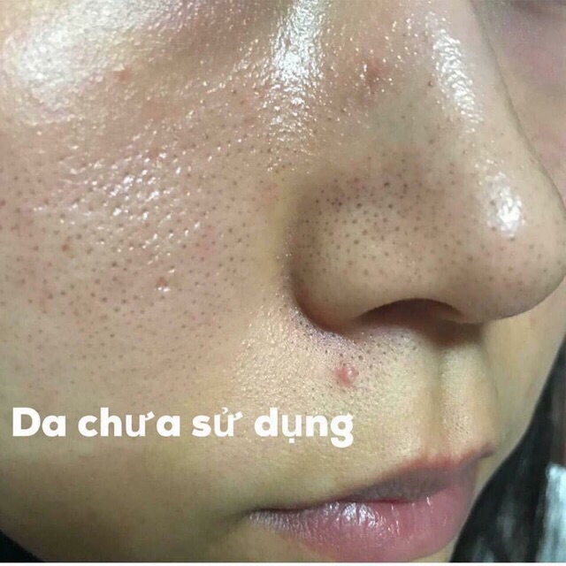 Nước Hoa Hồng Toner Bigansui Meishoku Mụn - Lotion mụn Meishoku bigansui