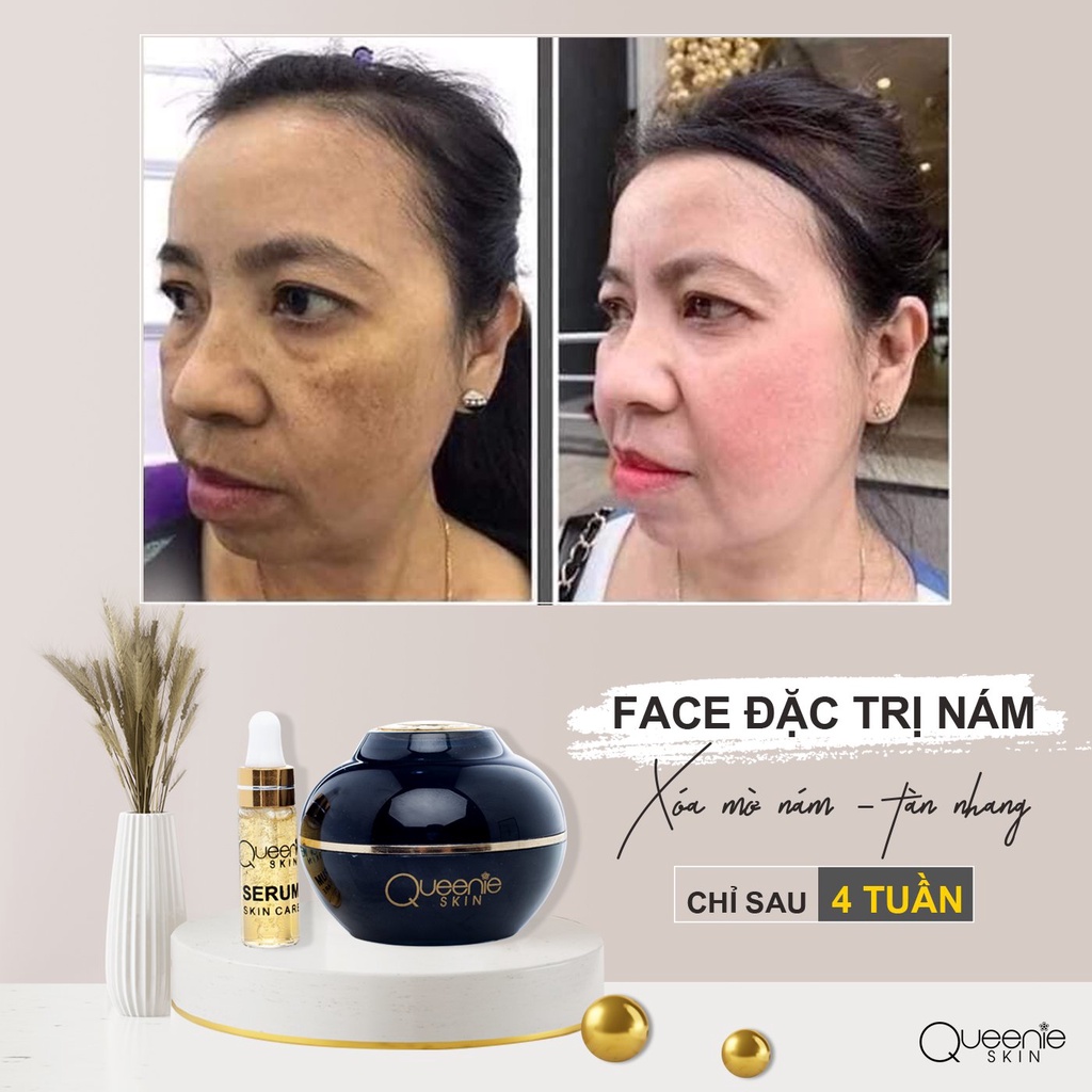 [FreeShip + Tặng Viên Uống &amp; Huyết Thanh Trắng Da] Kem Nám Queenie Skin Chính Hãng - Kem Ngừa Nám Queenie Skin Date 2024