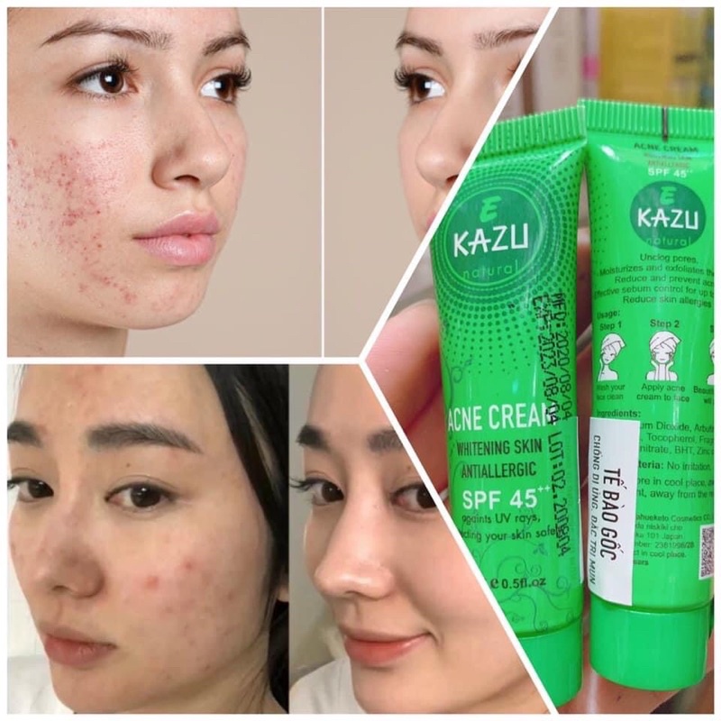 NGỪA MỤN -THÂM- XẸP MỤN