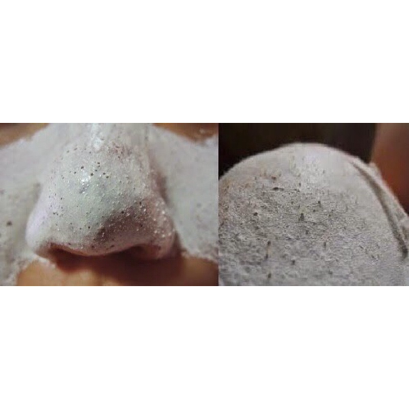 Lột mụn peeling pack | BigBuy360 - bigbuy360.vn