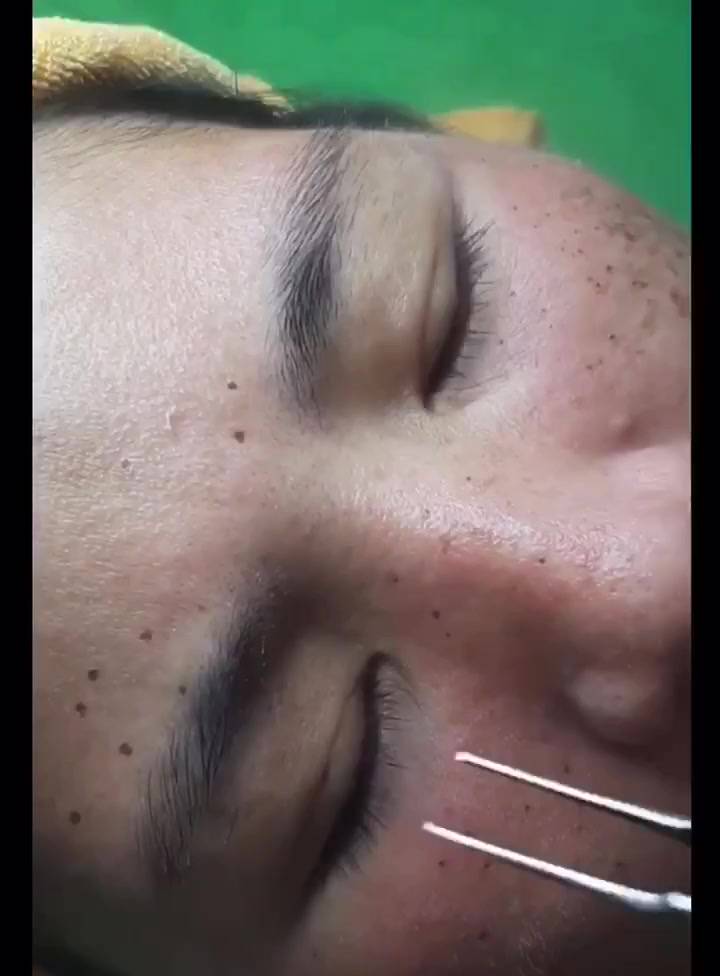 (Bán sỉ) Chấm nám tàn nhang loại 1, bong đẹp Handmade | BigBuy360 - bigbuy360.vn