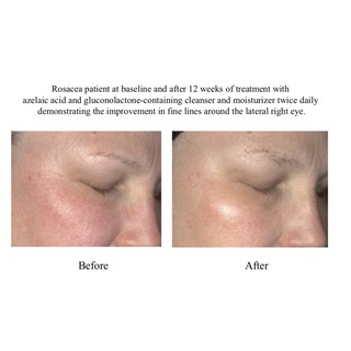 Serum Trị Mụn SVR Sebiaclear Serum 30ml