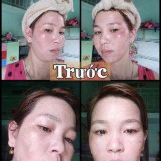 Kem Trắng Da Xóa Nám Sạm Cao Cấp