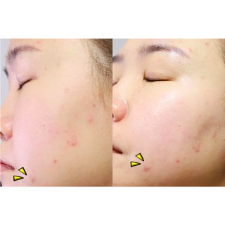 Mặt Nạ Dưỡng Da Trị Mụn Từ Rau Má Benton Goodbye Redness Centella Mask Pack