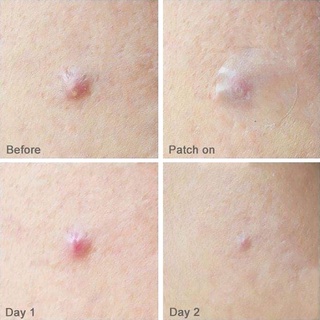 Miếng Dán Mụn Cosrx Acne Pimple Master Patch 24 miếng