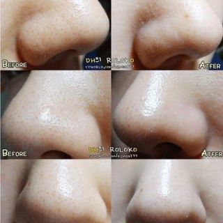 LỘT MỤN ĐẦU ĐEN GOODBYE BLACKHEAD