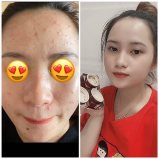 Cao sâm mụn đỏ hàng chính hãng