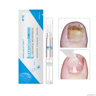 Bút điều trị nấm móng chống nấm thành phần thảo dược