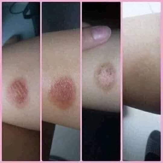 Serum Mờ Thâm Đầu Gối Khuỷu Tay Nách Môi Phúc Minh Tâm - Dưỡng Ẩm Mờ Thâm