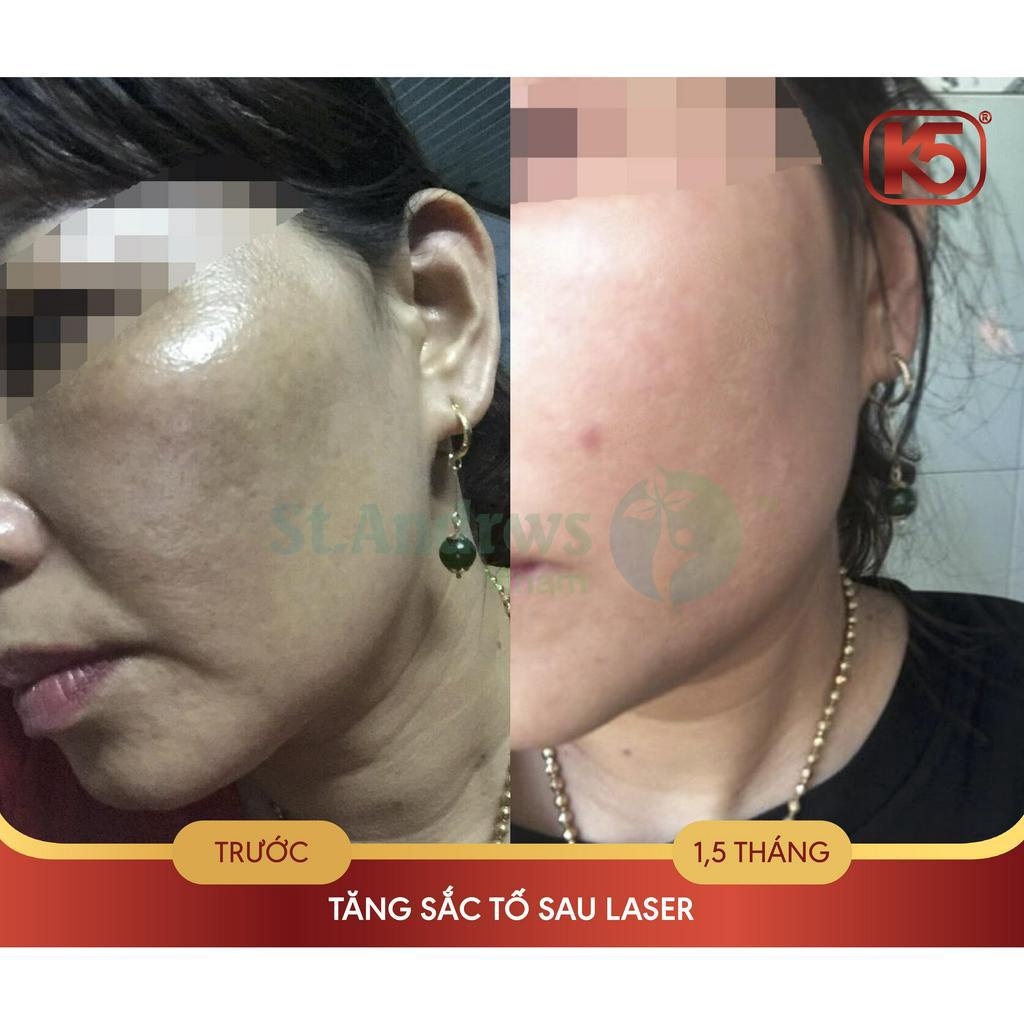 Kem chống tăng sắc tố sau lăn kim, phi kim tốt nhất hiện nay K5 Cryolaser 20ml