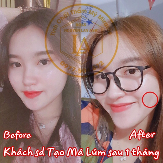 Tinh Chất Tạo Má Núm Đồng Tiền Miracle