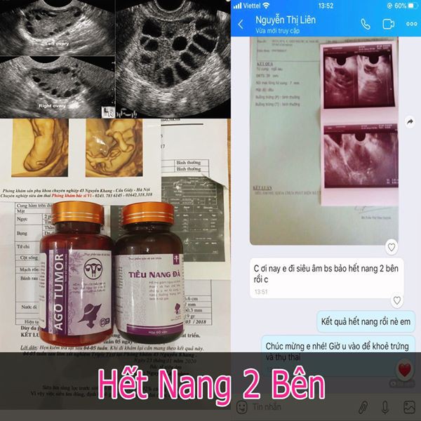 [CHÍNH HÃNG] Ago Tumor hỗ trợ điều trị u xơ tử cung u nang, đa nang buồng trứng, u tuyến vú lành tính