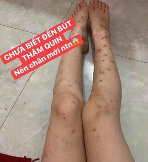 BÚT XOÁ SẸO THÂM