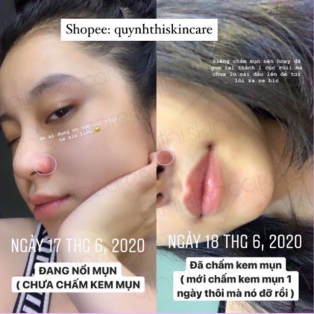 Chấm mụn Quỳnh Thi - 𝑨𝑵𝑻𝑰 𝑨𝑪𝑵𝑬 𝑪𝑹𝑬𝑨𝑴 𝑸𝑻 chấm mụn | BigBuy360 - bigbuy360.vn