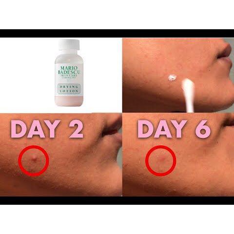 Gel chấm mụn Mario Badescu